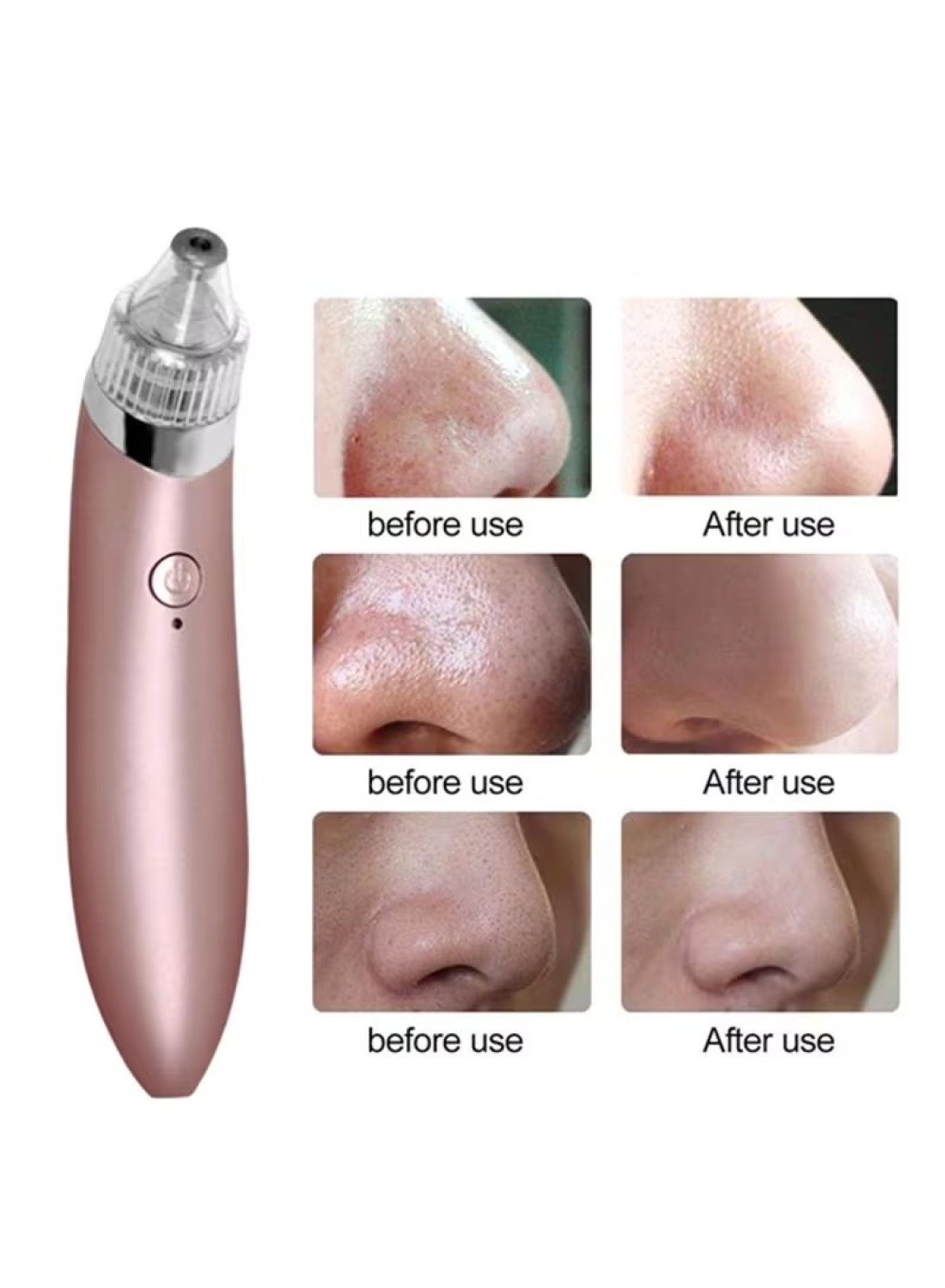 Generic Vacuum Facial Pore Cleanser Electric Blackhead Remover 180X42X39Millimeter