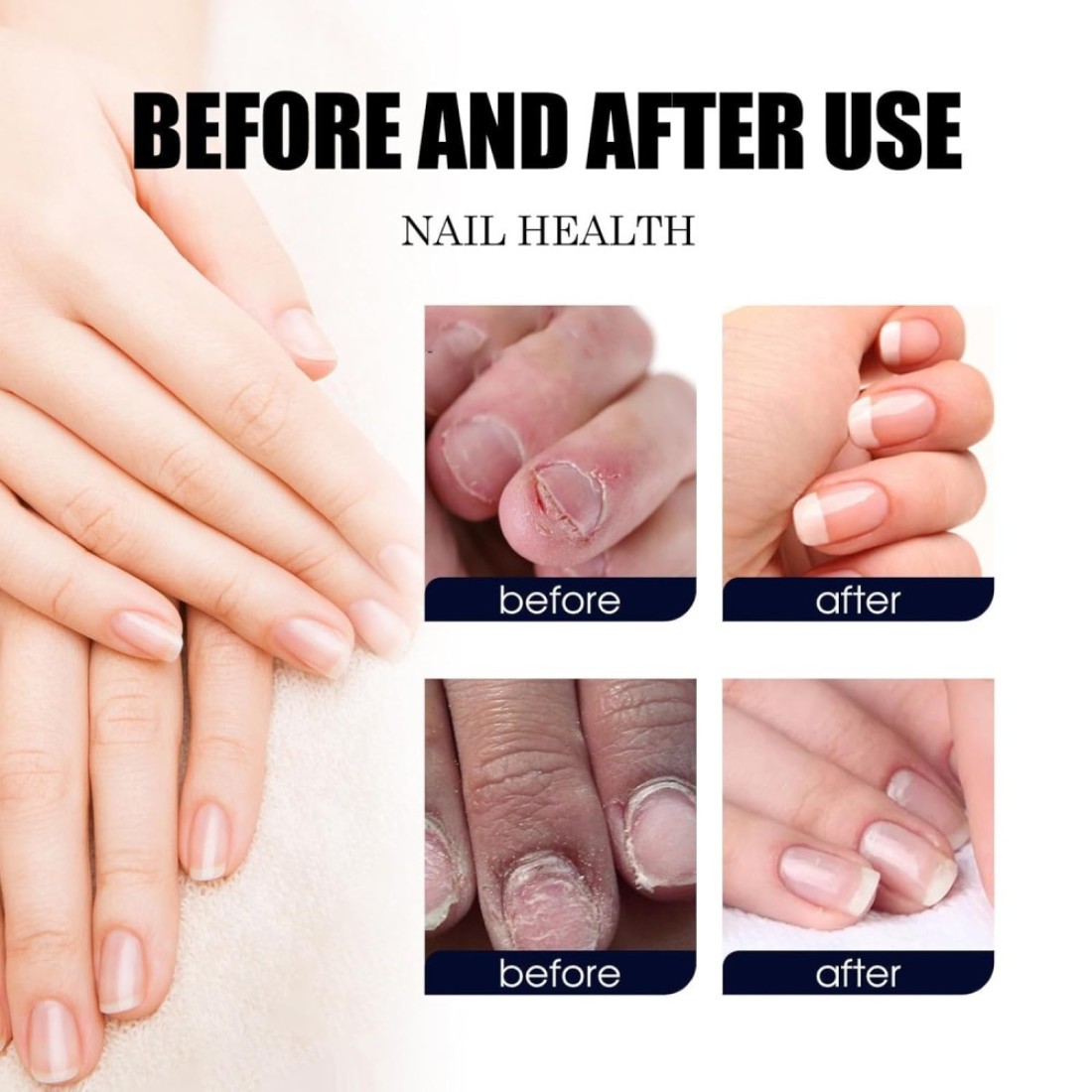 Plant Drops - Plant Drops for Nails Care, Oregano Tea Tree, Tea Tree and Oregano Oil for Toenail 10 ml/0.34 Fl.oz