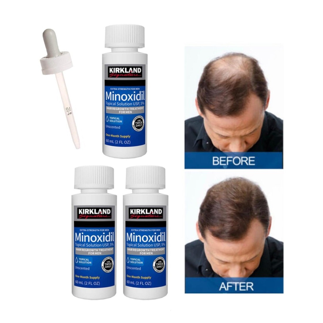 Pack Of 3 Minoxidil 5% Extra Strength Hair Regrowth Bottles 60ml