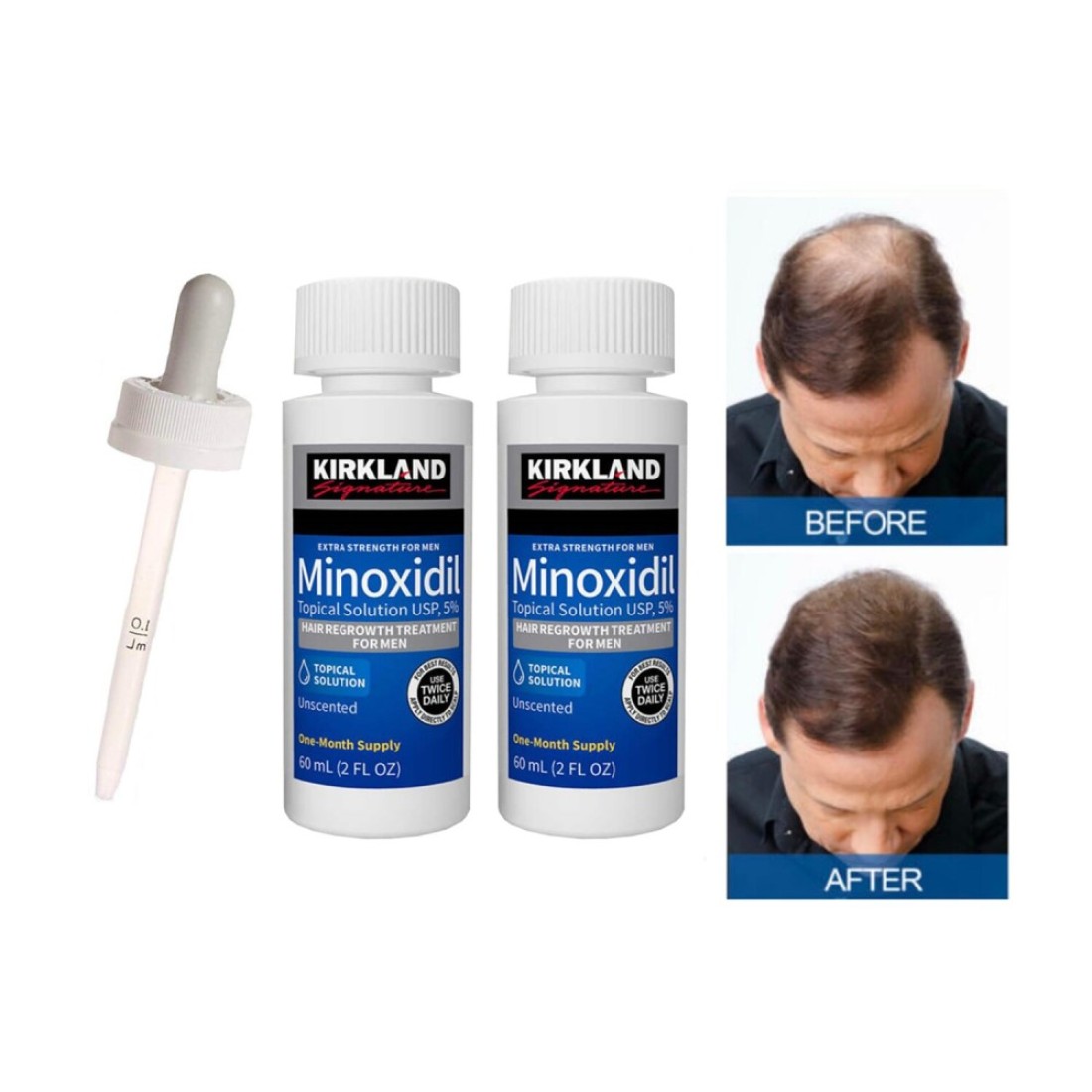 2-Pack Minoxidil 5% Extra Strength Hair Regrowth Solution &ndash; 60ml Bottles for Rapid, Thicker, and Fuller Hair Growth